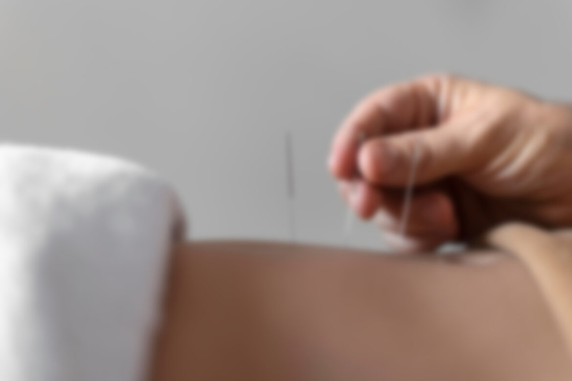 Dry Needling